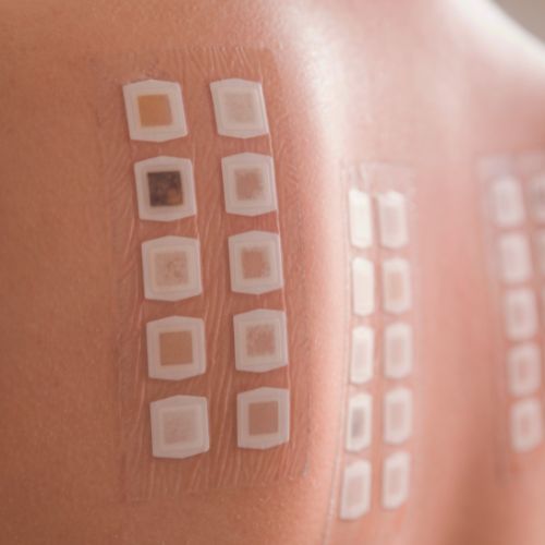 Epicutan teszt - Allergiaközpont