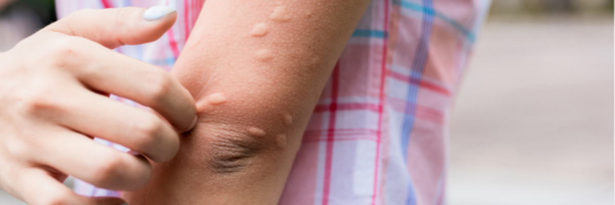 A szúnyogcsípés is okozhat súlyos bőrtüneteket – ez a teendő vele