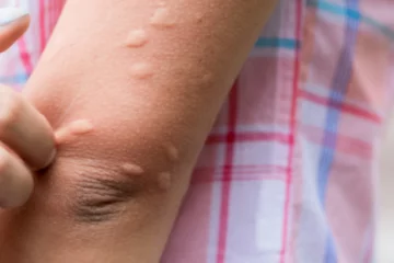 A szúnyogcsípés is okozhat súlyos bőrtüneteket – ez a teendő vele